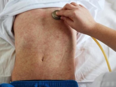 Se registraron 85 casos de Sarampión